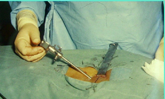 جراحة العمود الفقري باستخدام المنظار
