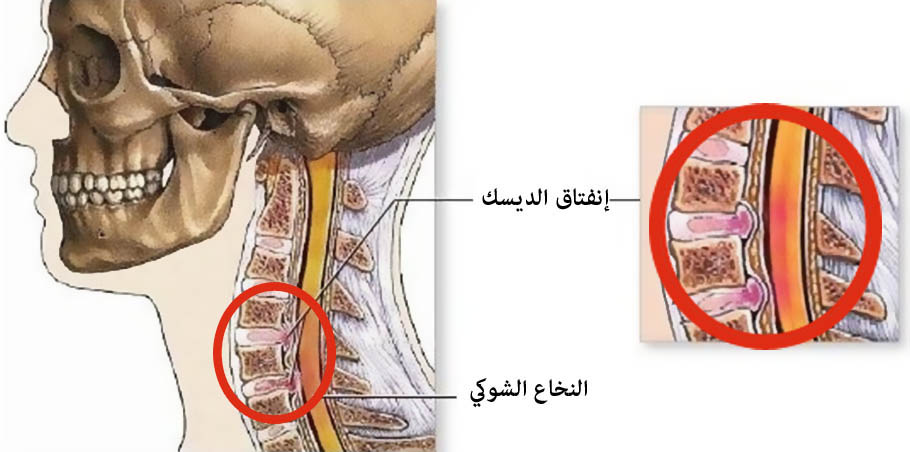 العمود الفقري العنقي - الإنزلاق الغضروفي في فقرات العنق File_1341645580_889