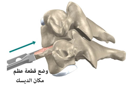 العمود الفقري العنقي - الإنزلاق الغضروفي في فقرات العنق File_1341646231_746