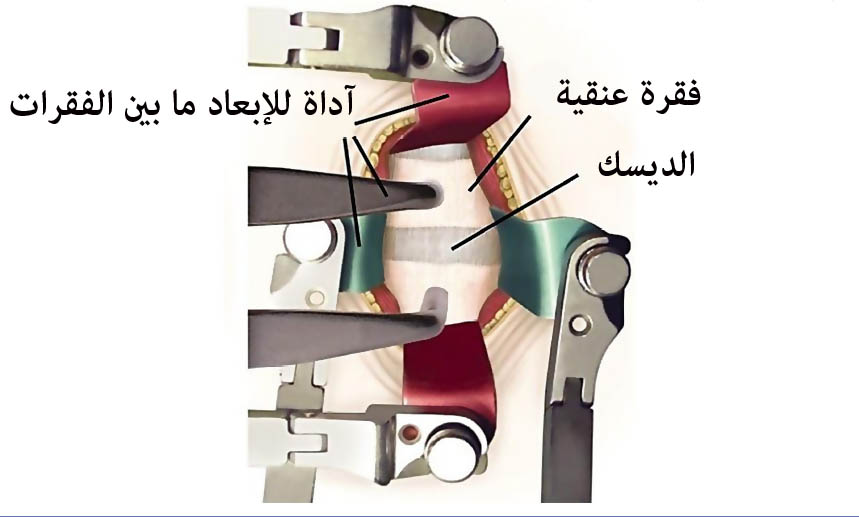 العمود الفقري العنقي - الإنزلاق الغضروفي في فقرات العنق File_1341647427_707