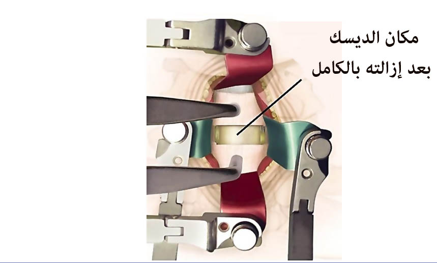 العمود الفقري العنقي - الإنزلاق الغضروفي في فقرات العنق File_1341647455_182