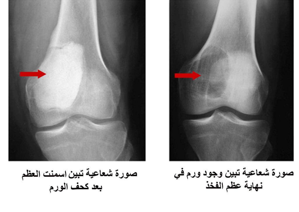 سرطان العظام بالصور